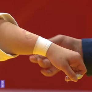 これが中国柔道女子選手が噛んだ歯形だ！（ＴＢＳ映像より）