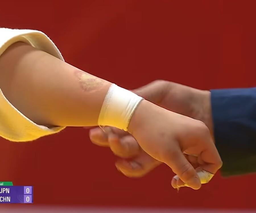 これが中国柔道女子選手が噛んだ歯形だ！（ＴＢＳ映像より）